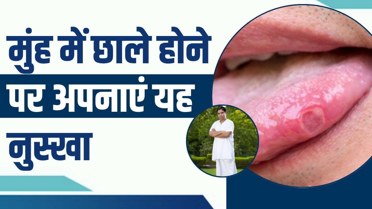 मुँह के छालो का जड़ से ख़त्म